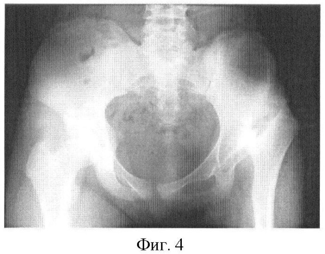Способ реконструкции бедренной кости при вывихе бедра (патент 2432919)