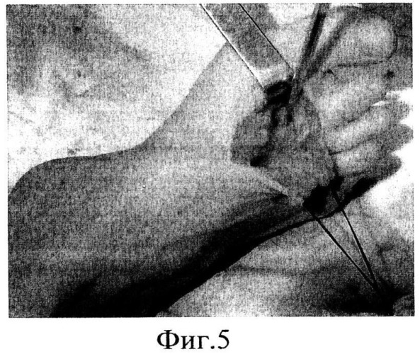Способ хирургического лечения остеомиелита головки второй плюсневой кости (патент 2543629)