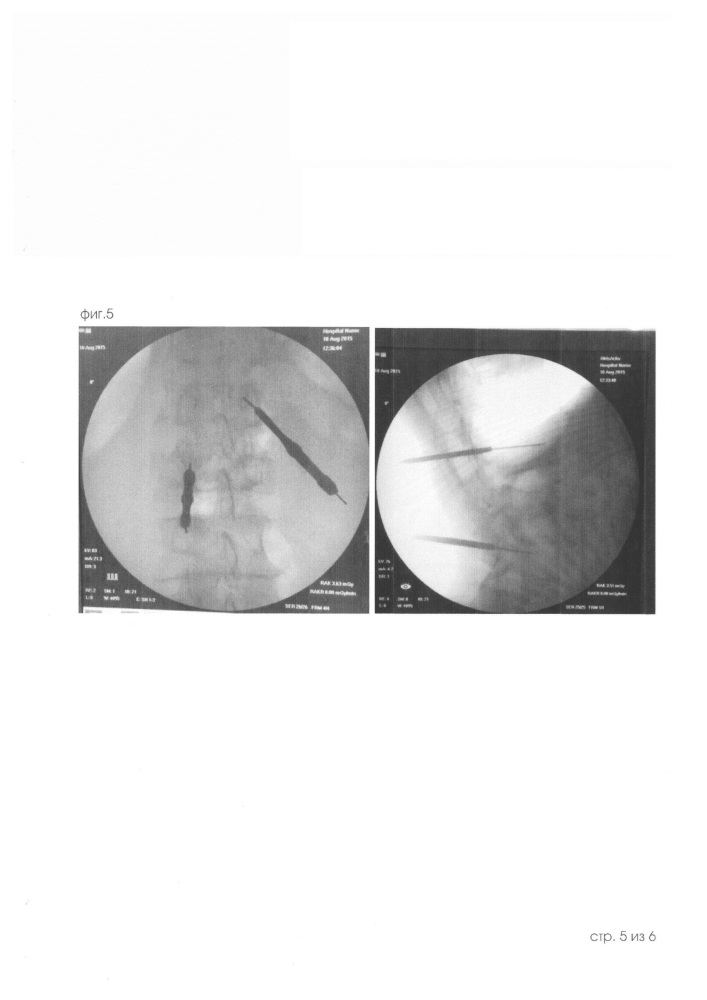 Способ снижения лучевой нагрузки при транскутанно-открытой установке транспедикулярных винтов в условиях параспинального минидоступа (патент 2613601)
