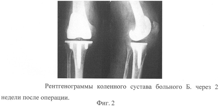 Способ лечения гнойного артрита, развившегося после тотального эндопротезирования коленного сустава (патент 2317022)