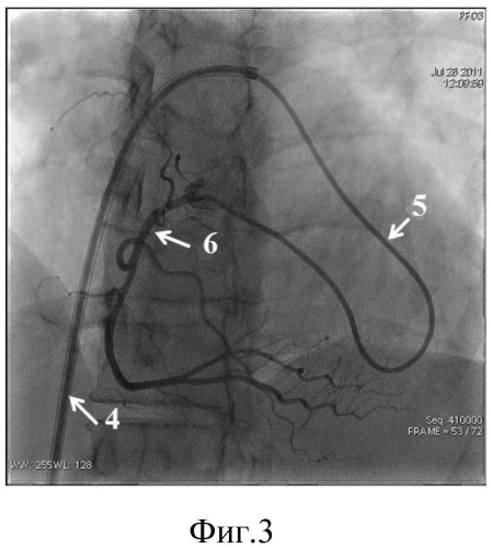 Способ катетеризации коронарных артерий и катетер для его реализации (патент 2556778)