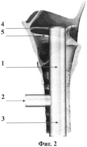 Способ подбора длины т-образной трубки в лечении хронических стенозов гортани (патент 2432969)