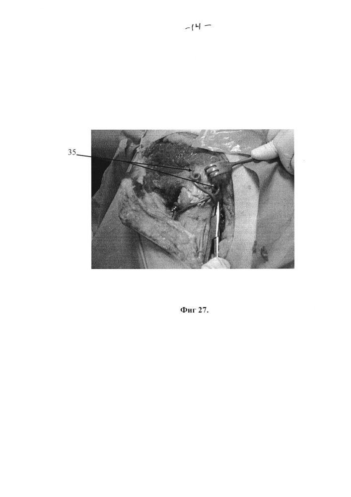 Способ экспериментального анатомо-хирургического обоснования оперативного доступа к тазобедренному суставу при чрезвертлужных переломах костей таза (патент 2629628)