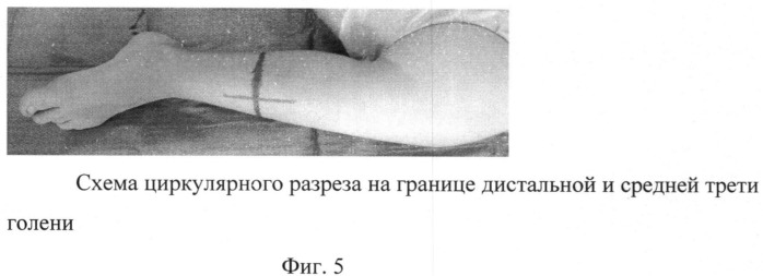 Способ ротационной остеопластики при проксимальных эктромелиях бедра (патент 2519381)