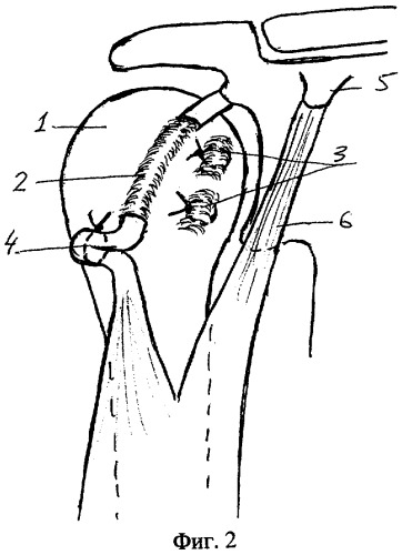 Способ хирургического лечения привычного вывиха плеча (патент 2283629)