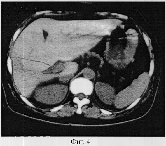 Способ компьютерно-томографической диагностики аномалий развития печени (патент 2297793)
