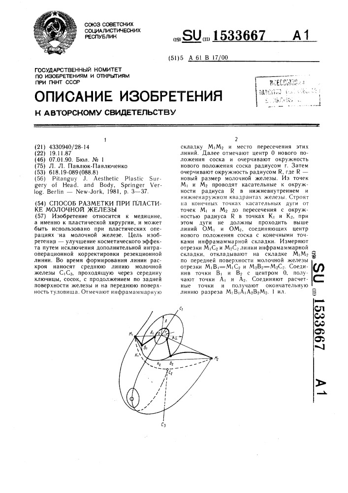 Способ разметки при пластике молочной железы (патент 1533667)