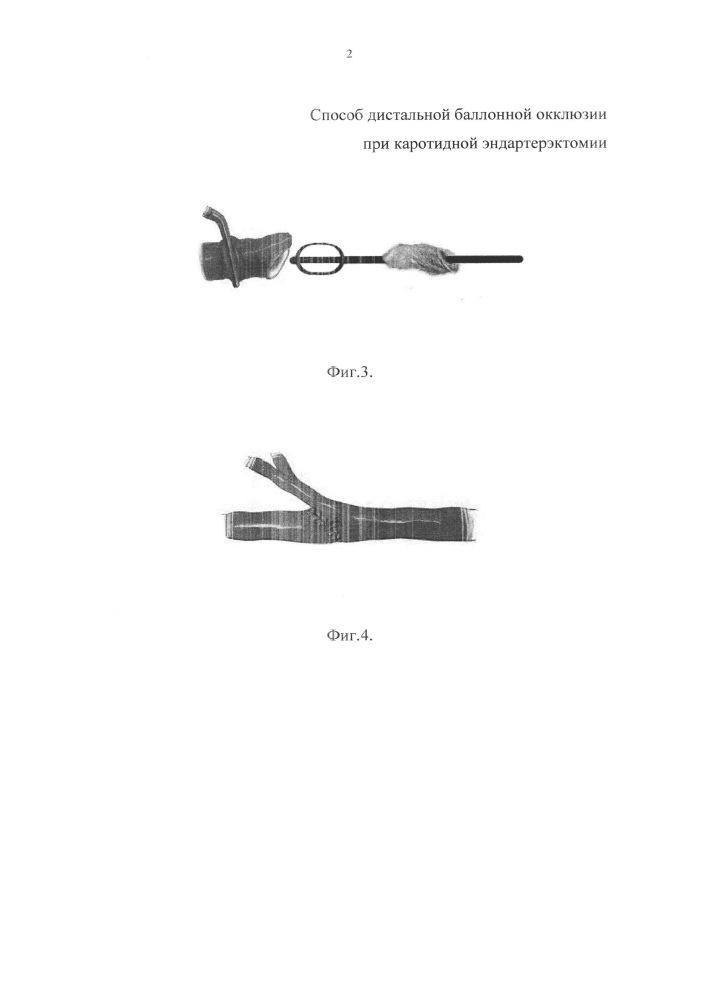 Способ дистальной баллонной окклюзии при каротидной эндартерэктомии (патент 2639802)