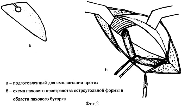 Пластика по бассини при паховой грыже