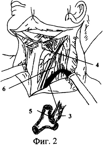 Способ профилактики лимфореи при травматических операциях в надключичной области слева (патент 2328985)