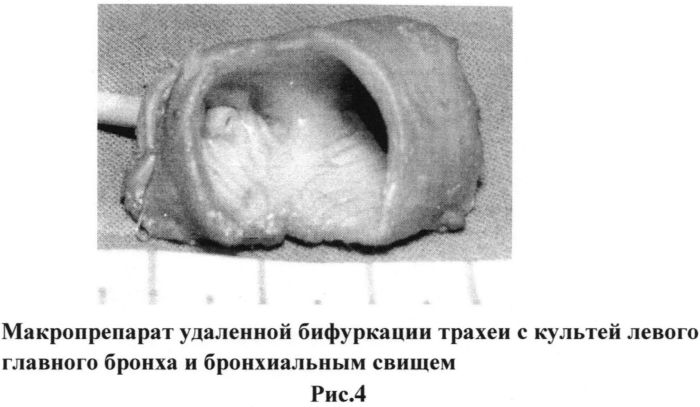 Способ хирургического лечения бронхоплеврального свища, возникшего после полного удаления легкого (патент 2558455)