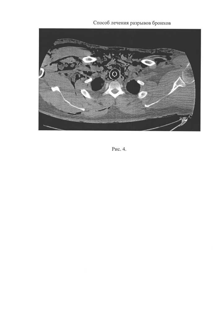 Способ лечения разрывов крупных бронхов (патент 2651691)