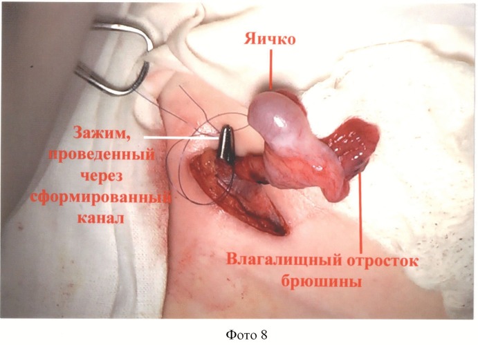 Способ низведения яичка при абдоминальной ретенции после пересечения тестикулярных сосудов (патент 2498780)