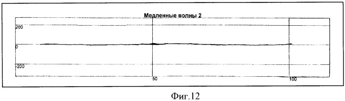 Способ определения типа демпинг-реакции при демпинг-синдроме (патент 2334456)