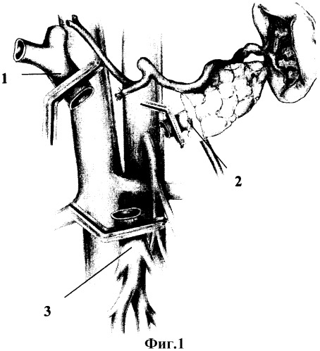 Способ панкреатодуоденальной резекции при местнораспространенном раке периампулярной области с обширной опухолевой инвазией магистральных вен мезентерико-портальной системы (патент 2312608)