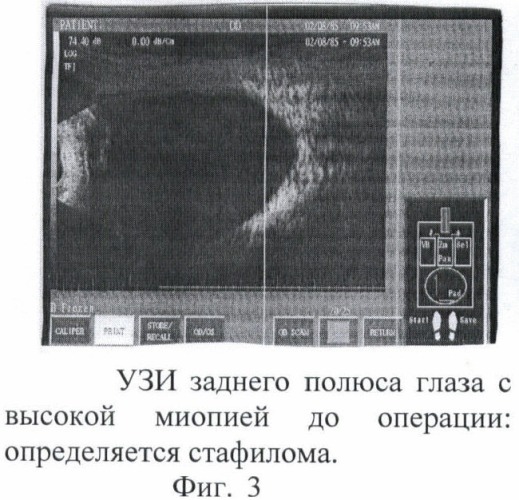 Способ склерореконструктивного лечения высокой близорукости (патент 2367394)