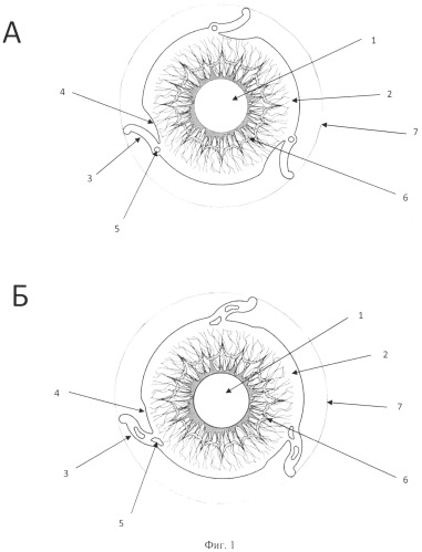 Иридохрусталиковая диафрагма и способ ее изготовления (патент 2526245)