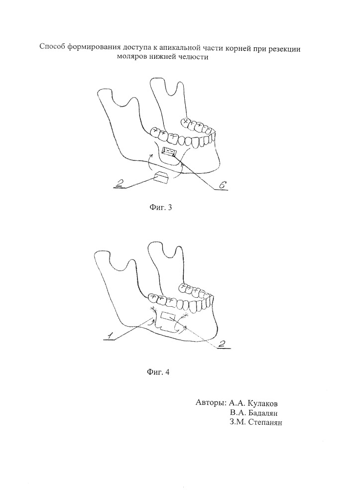 Способ формирования доступа к апикальной части корней при резекции моляров нижней челюсти (патент 2655082)