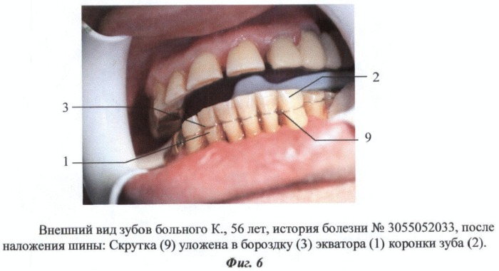 Способ шинирования зубов при пародонтите (патент 2436540)