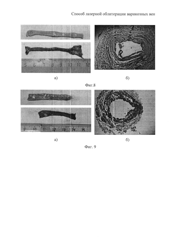 Способ лазерной облитерации варикозных вен (патент 2591841)