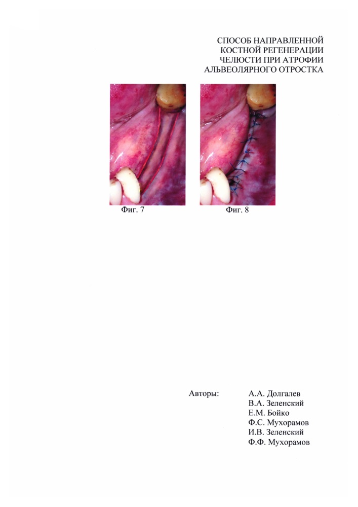 Способ направленной костной регенерации челюсти при атрофии альвеолярного отростка (патент 2648861)