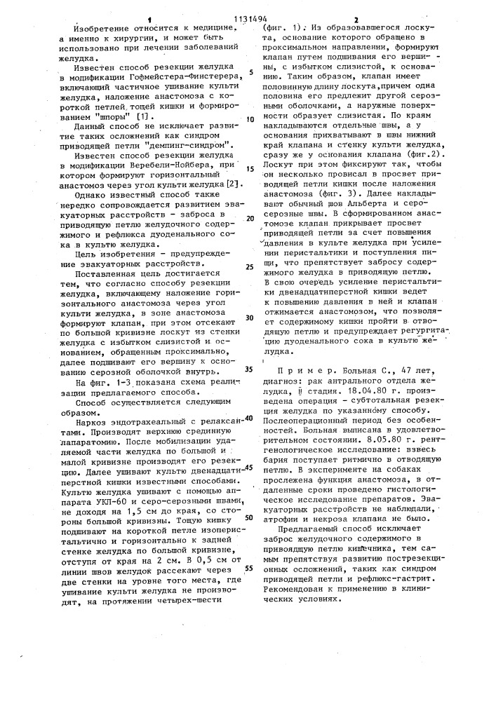 Способ резекции желудка (патент 1131494)
