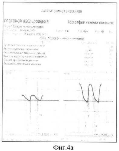 Способ лечения врожденной косолапости у детей первого года жизни (патент 2419405)