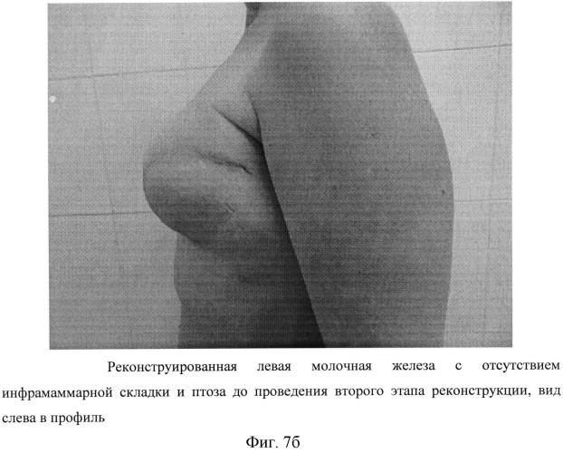 Способ формирования инфрамаммарной складки при двухэтапной реконструкции молочной железы (патент 2567790)