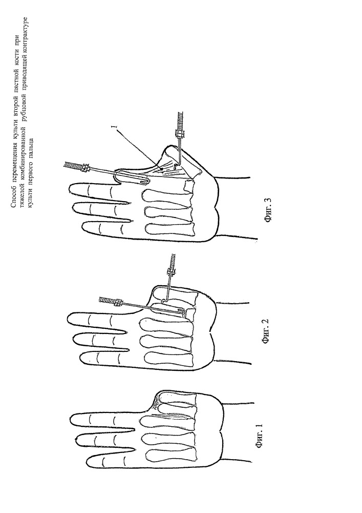 Способ перемещения культи второй пястной кости при тяжелой комбинированной рубцовой приводящей контрактуре культи первого пальца (патент 2662649)