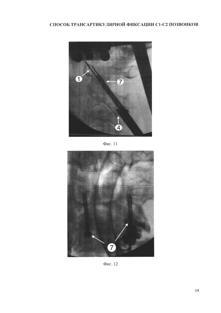 Способ выполнения трансартикулярной фиксации с1-с2 позвонков (патент 2662203)