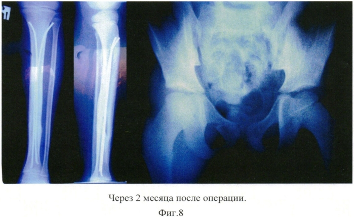 Способ прогнозирования полиорганных нарушений с целью определения оптимального времени проведения остеосинтеза при сочетанной и множественной травме у детей (патент 2569727)