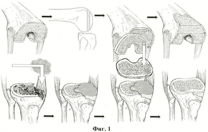 Асептический некроз мыщелков бедренной. Дисплазия блока бедренной кости классификация. Эндопротез бедренной кости коленного сустава. Эндопротезирование мыщелка большеберцовой кости. Асептический некроз внутреннего мыщелка бедренной кости.