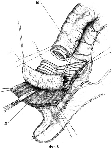 Способ толстокишечной гастропластики после гастрэктомии (патент 2278619)