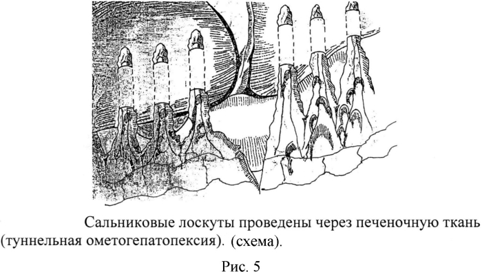 Способ хирургического лечения цирроза печени в эксперименте (патент 2570526)