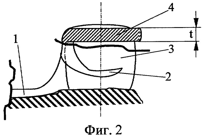 Устройство для крепления бюгельного протеза (патент 2251993)