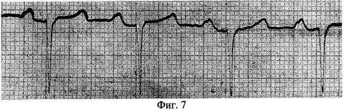 Способ электрокардиографической диагностики миокардиодистрофии у новорожденных телят (патент 2292840)