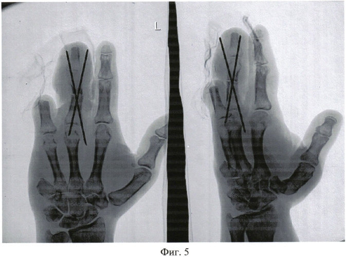 Способ пересадки пятого пястно-фалангового сустава для замещения дефекта третьего пальца кисти (патент 2556616)