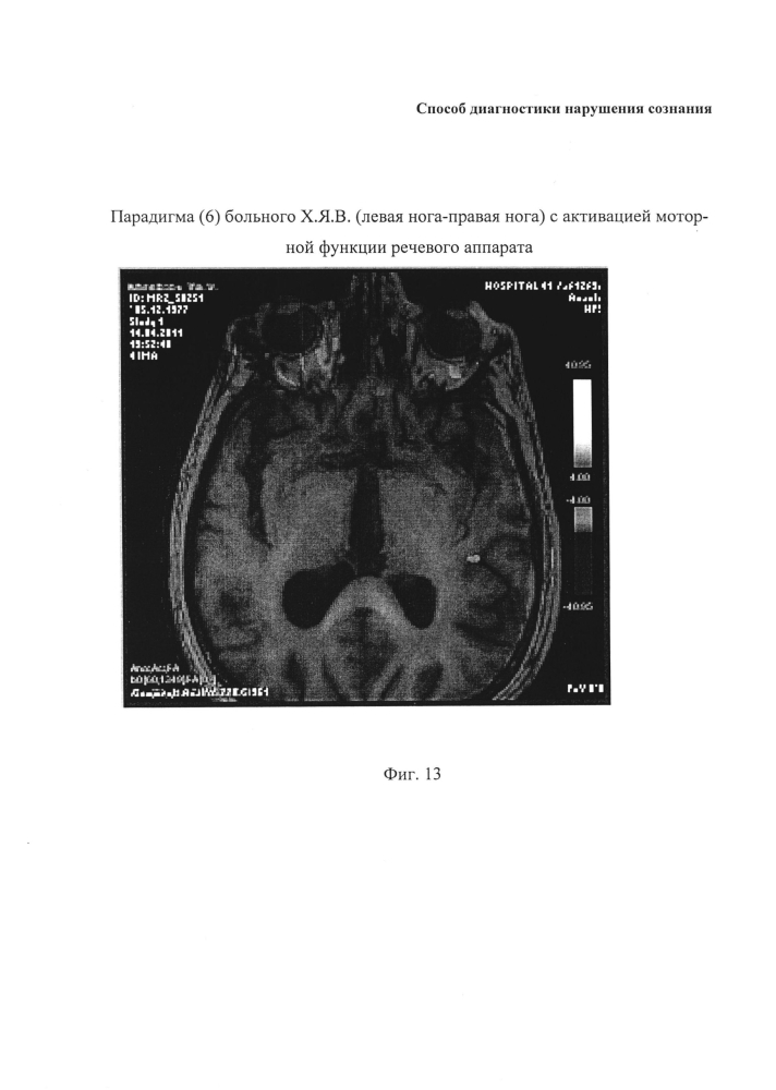 Способ диагностики нарушения сознания (патент 2596049)