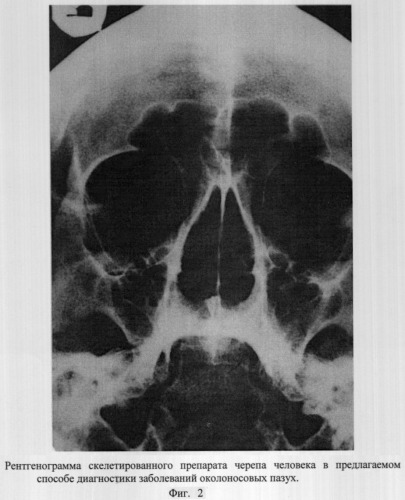 Способ рентгенографии околоносовых пазух (патент 2309676)