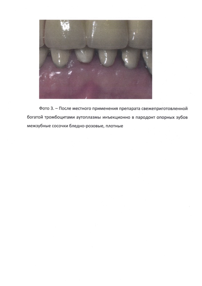 Способ локальной иммунокоррекции у стоматологических ортопедических пациентов (патент 2643107)