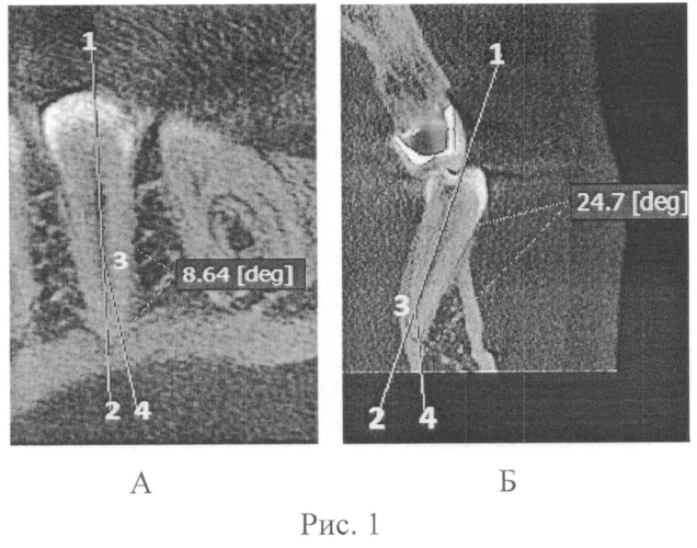Способ измерения кривизны корневого канала зуба (патент 2550686)