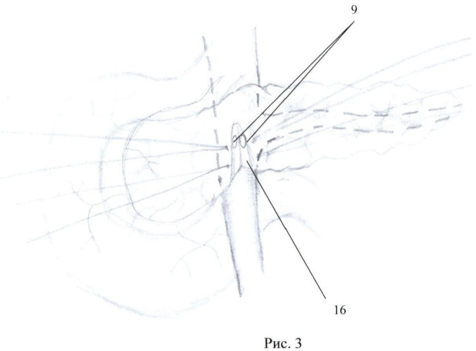 Способ поперечного пересечения поджелудочной железы (патент 2476162)