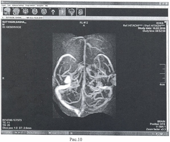 Способ визуализации сосудов головного мозга (патент 2454936)