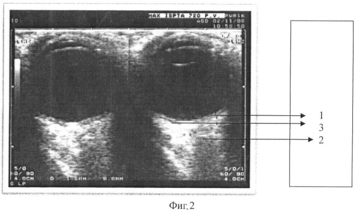 Способ прогнозирования отслойки сосудистой оболочки при операциях глаукомы с помощью ультразвуковых диагностических критериев (патент 2373860)
