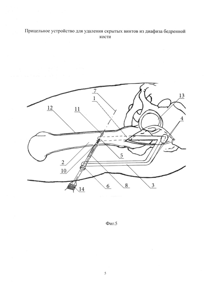 Прицельное устройство для удаления скрытых винтов из диафиза бедренной кости (патент 2614496)