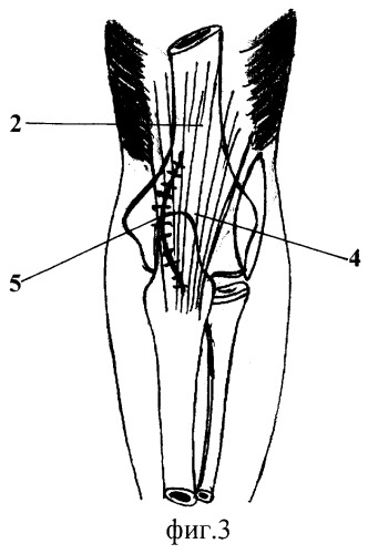 Способ удлинения сухожилия трехглавой мышцы плеча (патент 2268015)