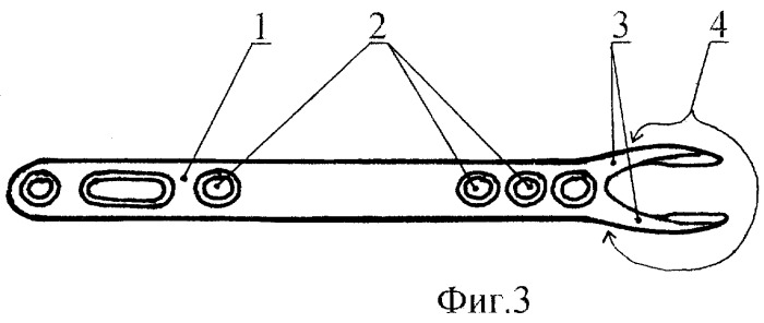 Вильчатая пластинка для остеосинтеза переломов и ложных суставов ключицы (патент 2254090)