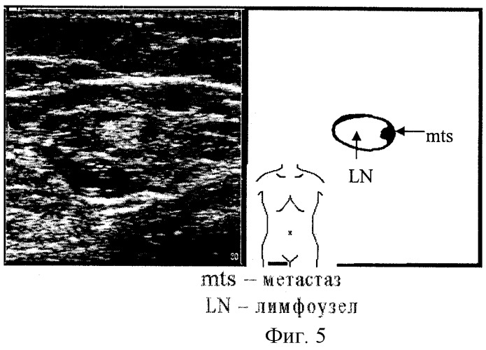 Способ ультразвуковой диагностики метастатического поражения регионарных лимфатических узлов (патент 2284754)