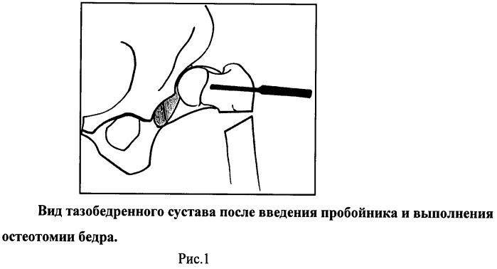 Способ хирургического лечения вывиха бедра у детей (патент 2502486)