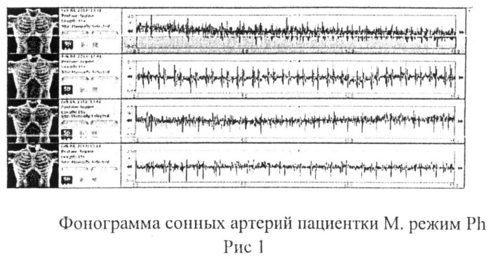 Способ экспресс-диагностики электронным стетоскопом littmann первопричины болевой патологии головы и шеи (патент 2495644)